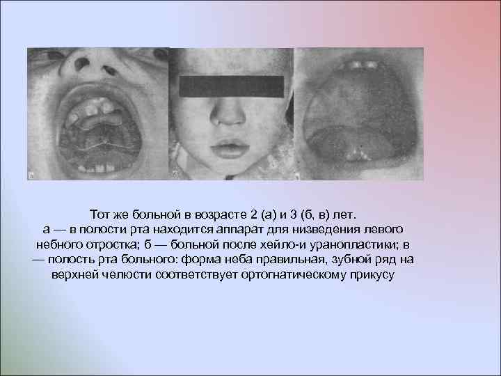Тот же больной в возрасте 2 (а) и 3 (б, в) лет. а —