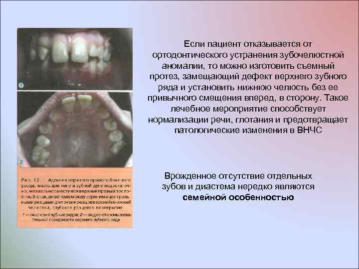 Если пациент отказывается от ортодонтического устранения зубочелюстной аномалии, то можно изготовить съемный протез, замещающий