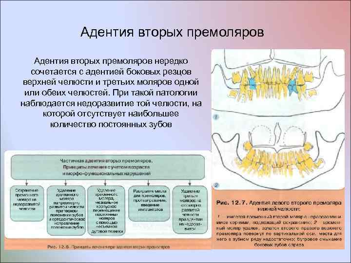 Адентия вторых премоляров нередко сочетается с адентией боковых резцов верхней челюсти и третьих моляров
