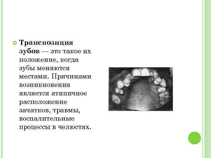  Транспозиция зубов — это такое их положение, когда зубы меняются местами. Причинами возникновения