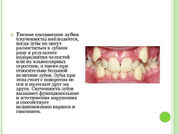  Тесное положение зубов (скученность) наблюдается, когда зубы не могут разместиться в зубном ряду