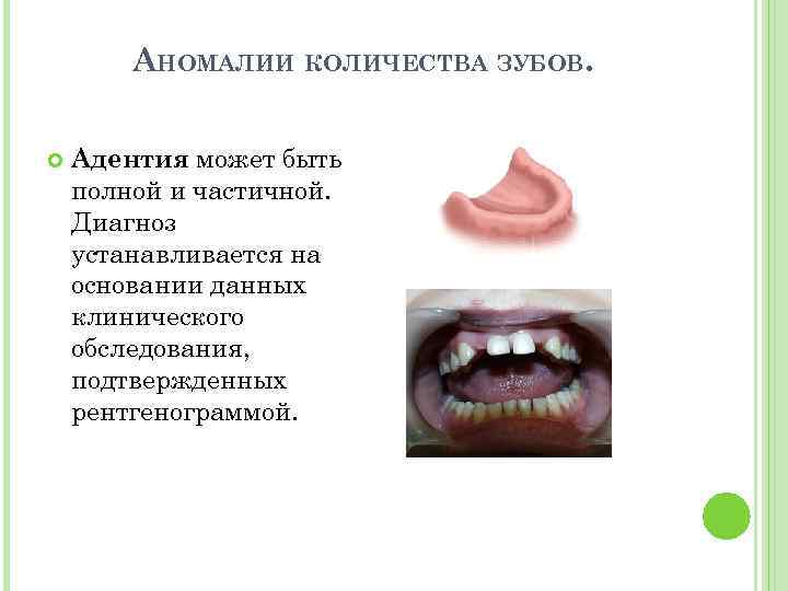 АНОМАЛИИ КОЛИЧЕСТВА ЗУБОВ. Адентия может быть полной и частичной. Диагноз устанавливается на основании данных