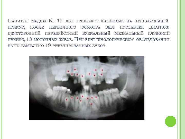 ПАЦИЕНТ ВАДИМ К. 19 ЛЕТ ПРИШЕЛ С ЖАЛОБАМИ НА НЕПРАВИЛЬНЫЙ ПРИКУС, ПОСЛЕ ПЕРВИЧНОГО ОСМОТРА