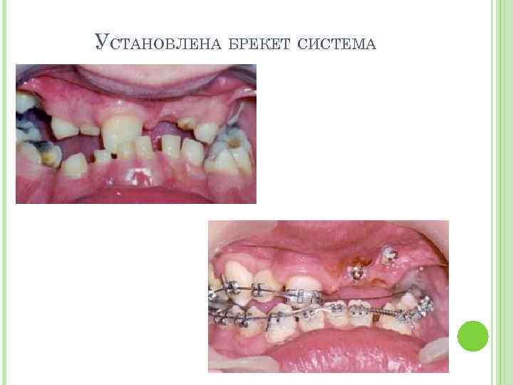 УСТАНОВЛЕНА БРЕКЕТ СИСТЕМА 