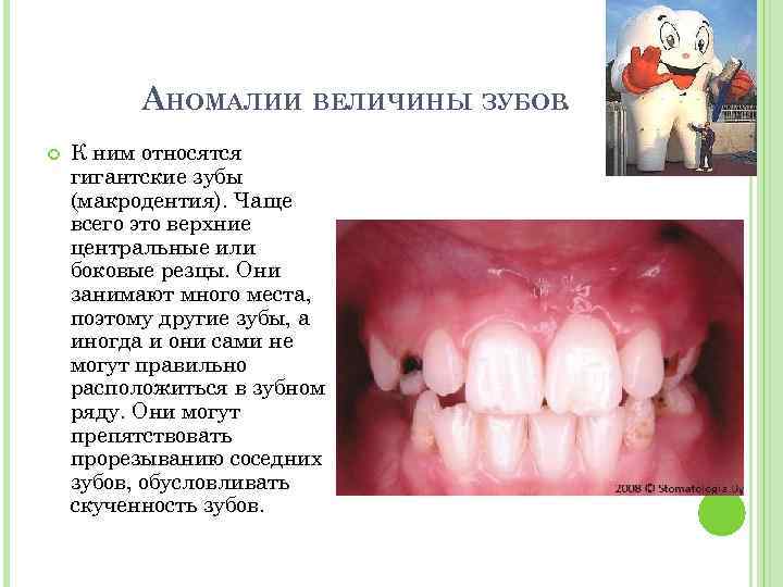 АНОМАЛИИ ВЕЛИЧИНЫ ЗУБОВ. К ним относятся гигантские зубы (макродентия). Чаще всего это верхние центральные