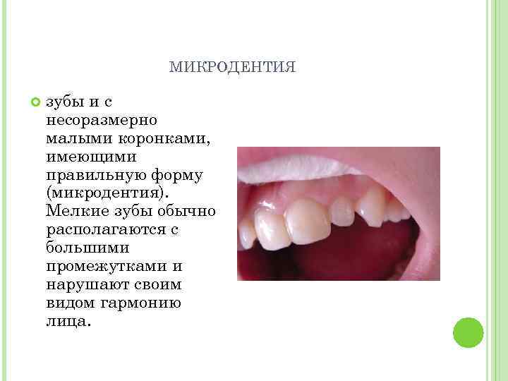 МИКРОДЕНТИЯ зубы и с несоразмерно малыми коронками, имеющими правильную форму (микродентия). Мелкие зубы обычно