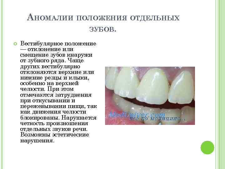 АНОМАЛИИ ПОЛОЖЕНИЯ ОТДЕЛЬНЫХ ЗУБОВ. Вестибулярное положение — отклонение или смещение зубов кнаружи от зубного