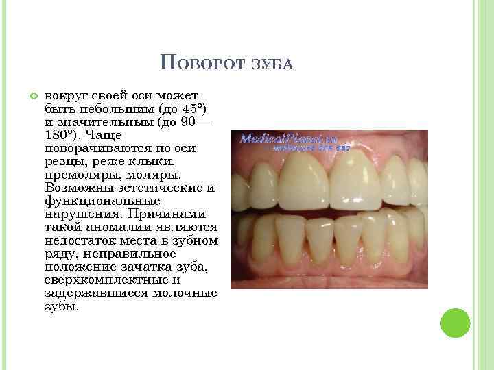 ПОВОРОТ ЗУБА вокруг своей оси может быть небольшим (до 45°) и значительным (до 90—