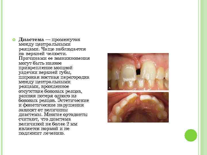  Диастема — промежуток между центральными резцами. Чаще наблюдается на верхней челюсти. Причинами ее