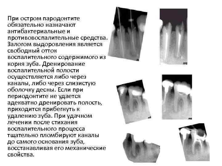 При остром пародонтите обязательно назначают антибактериальные и противовоспалительные средства. Залогом выдоровления является свободный отток