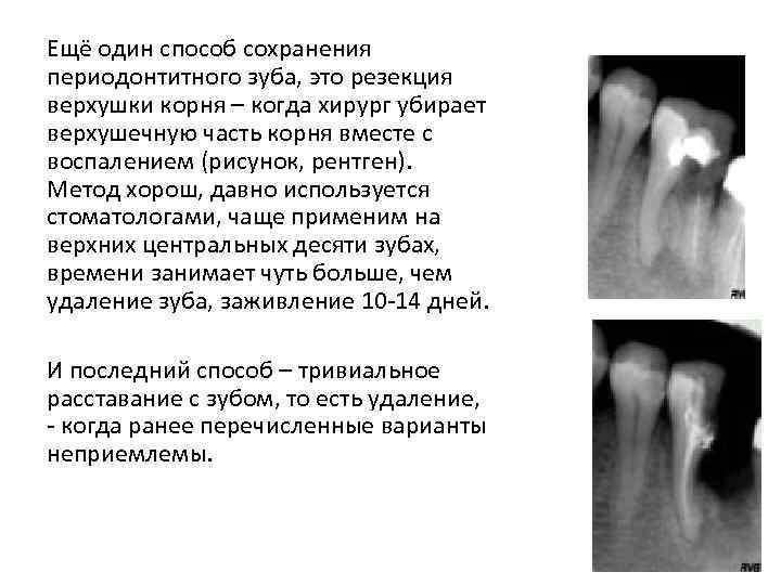 Ещё один способ сохранения периодонтитного зуба, это резекция верхушки корня – когда хирург убирает