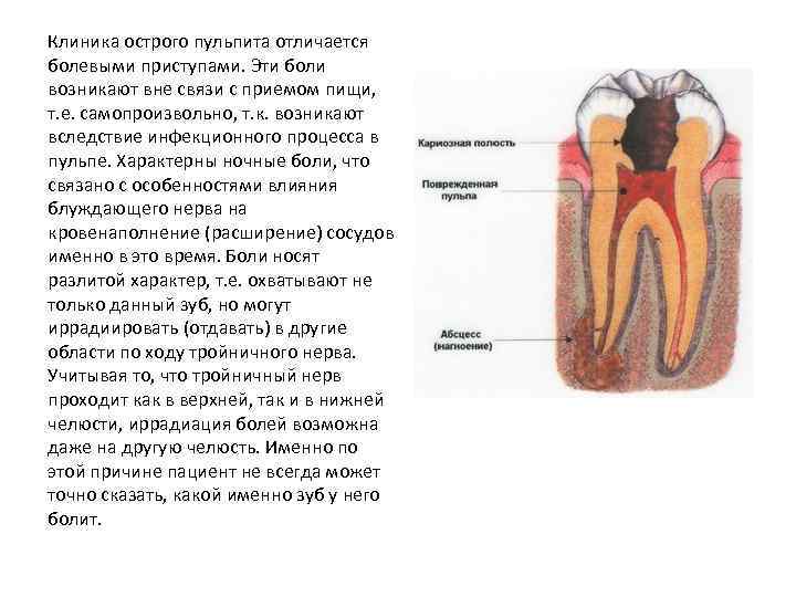 Клиника острого пульпита отличается болевыми приступами. Эти боли возникают вне связи с приемом пищи,