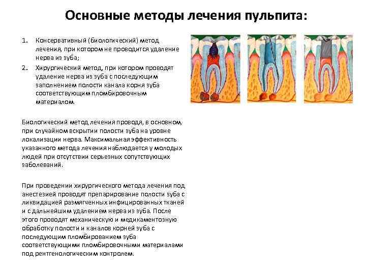 Основные методы лечения пульпита: 1. 2. Консервативный (биологический) метод лечения, при котором не проводится