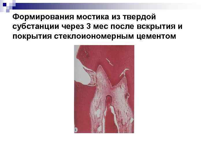 Формирования мостика из твердой субстанции через 3 мес после вскрытия и покрытия стеклоиономерным цементом