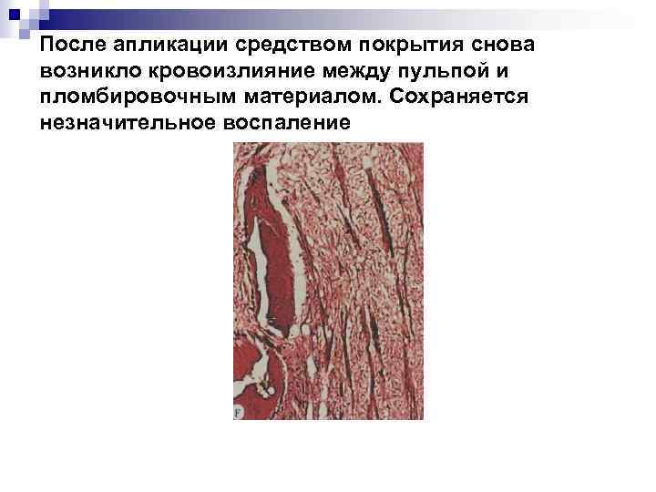 После апликации средством покрытия снова возникло кровоизлияние между пульпой и пломбировочным материалом. Сохраняется незначительное