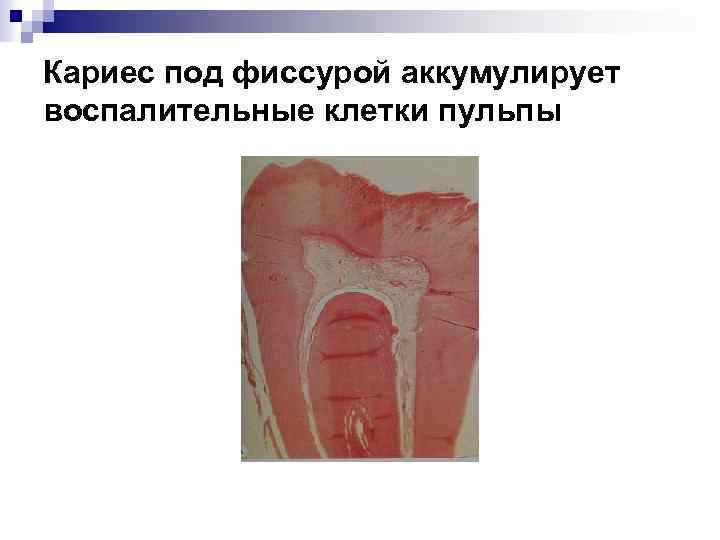 Кариес под фиссурой аккумулирует воспалительные клетки пульпы 