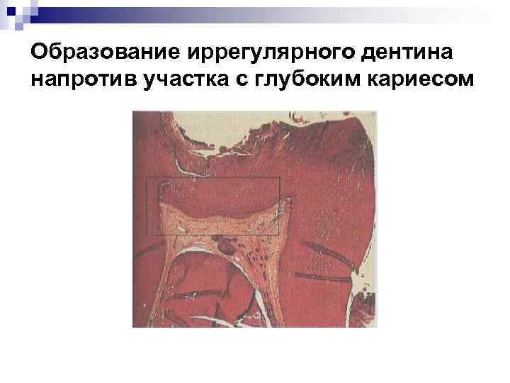 Образование иррегулярного дентина напротив участка с глубоким кариесом 
