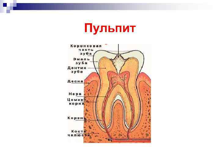 Пульпит 