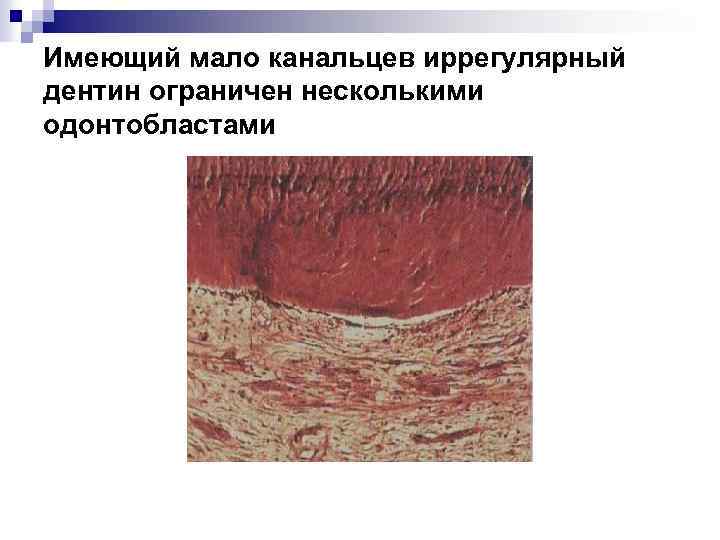 Имеющий мало канальцев иррегулярный дентин ограничен несколькими одонтобластами 
