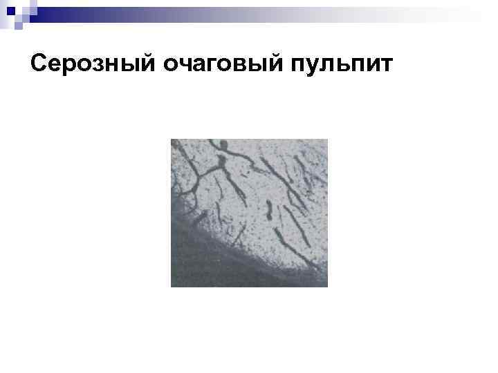 Серозный очаговый пульпит 