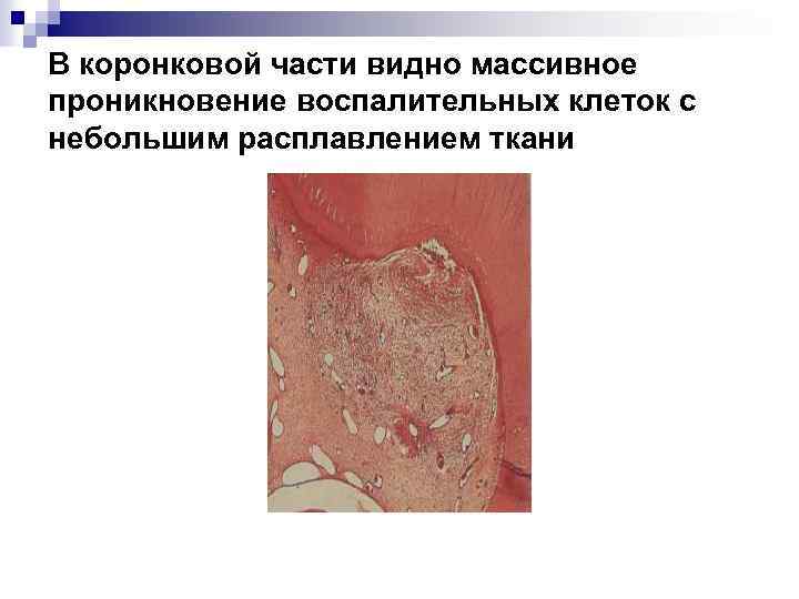 В коронковой части видно массивное проникновение воспалительных клеток с небольшим расплавлением ткани 