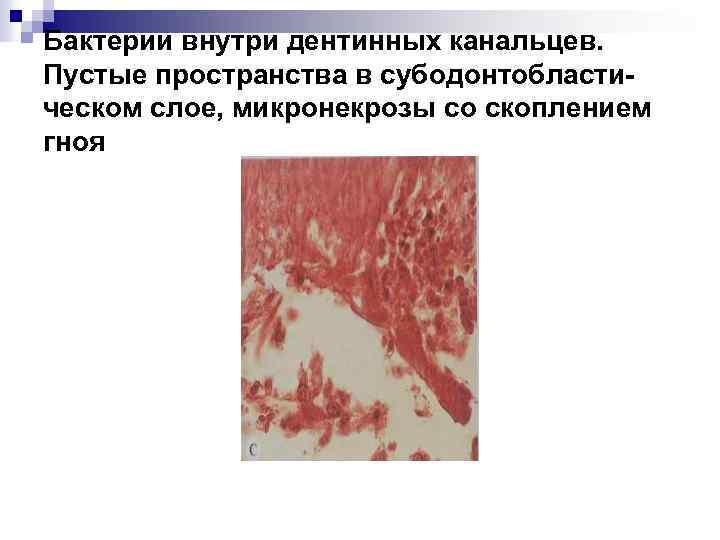 Бактерии внутри дентинных канальцев. Пустые пространства в субодонтобластическом слое, микронекрозы со скоплением гноя 