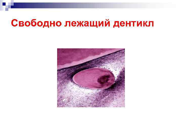 Свободно лежащий дентикл 