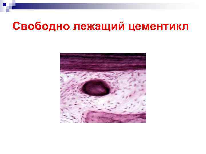 Свободно лежащий цементикл 