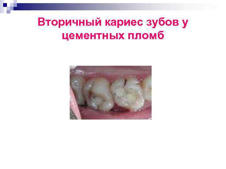 Вторичный кариес зубов у цементных пломб 