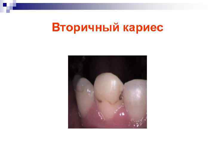 Вторичный кариес 