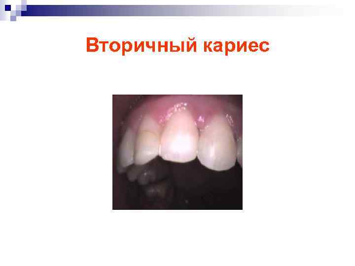 Вторичный кариес 