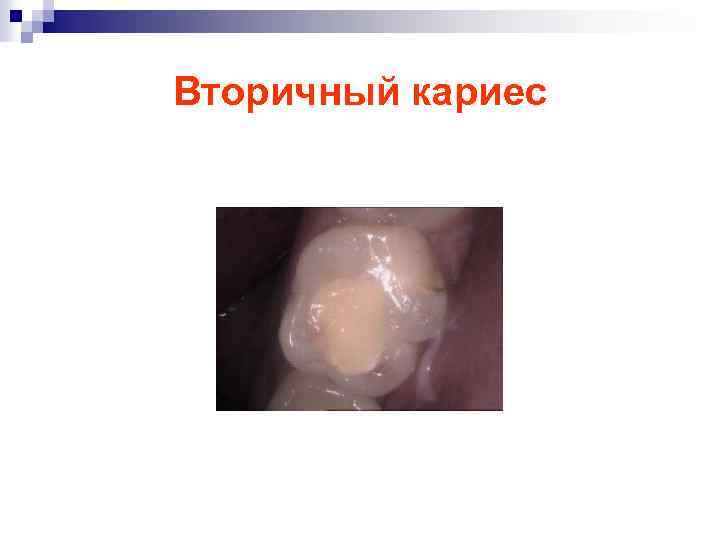 Вторичный кариес 
