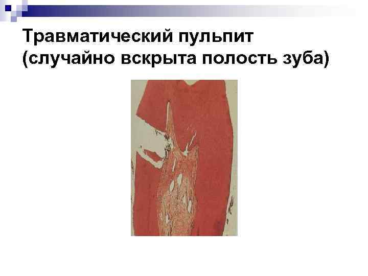 Травматический пульпит (случайно вскрыта полость зуба) 