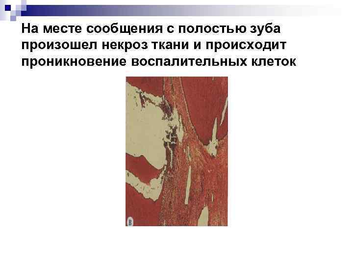 На месте сообщения с полостью зуба произошел некроз ткани и происходит проникновение воспалительных клеток