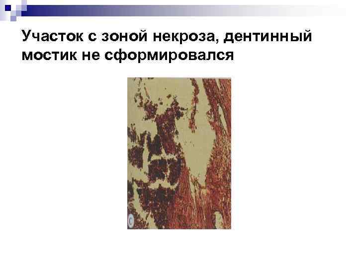 Участок с зоной некроза, дентинный мостик не сформировался 