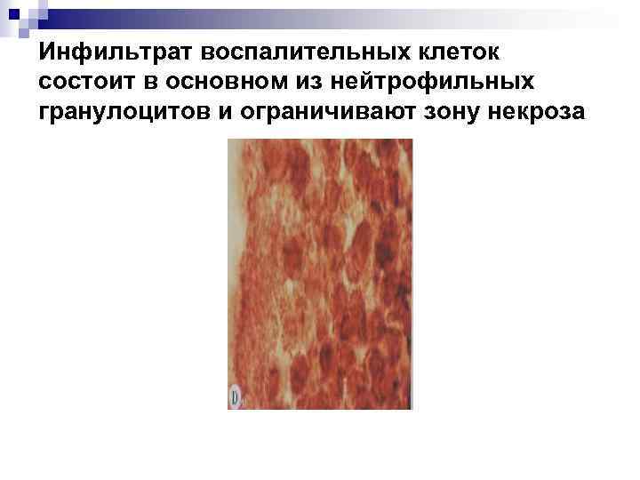 Инфильтрат воспалительных клеток состоит в основном из нейтрофильных гранулоцитов и ограничивают зону некроза 