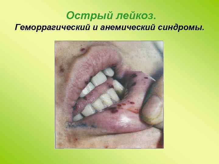 Острый лейкоз. Геморрагический и анемический синдромы. 
