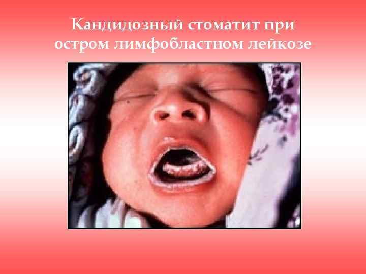 Кандидозный стоматит при остром лимфобластном лейкозе 