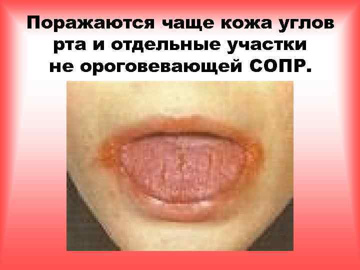 Поражаются чаще кожа углов рта и отдельные участки не ороговевающей СОПР. 
