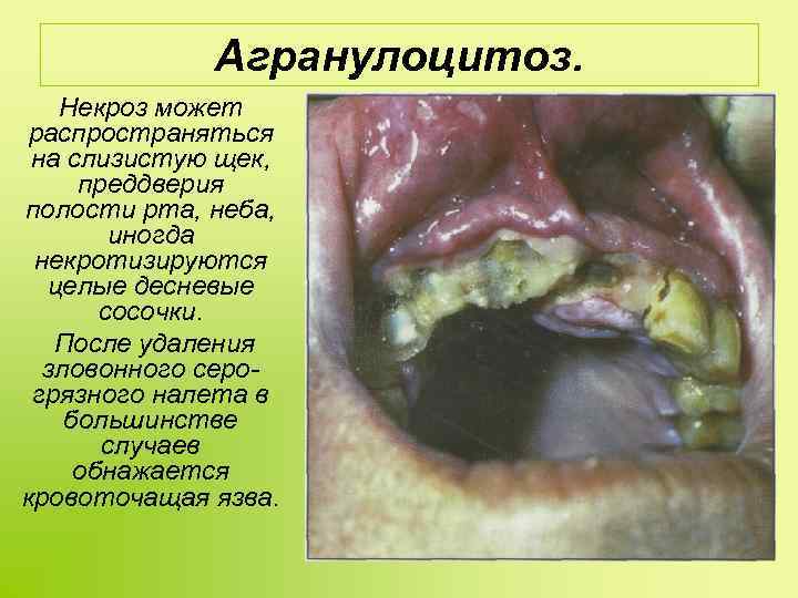 Агранулоцитоз. Некроз может распространяться на слизистую щек, преддверия полости рта, неба, иногда некротизируются целые
