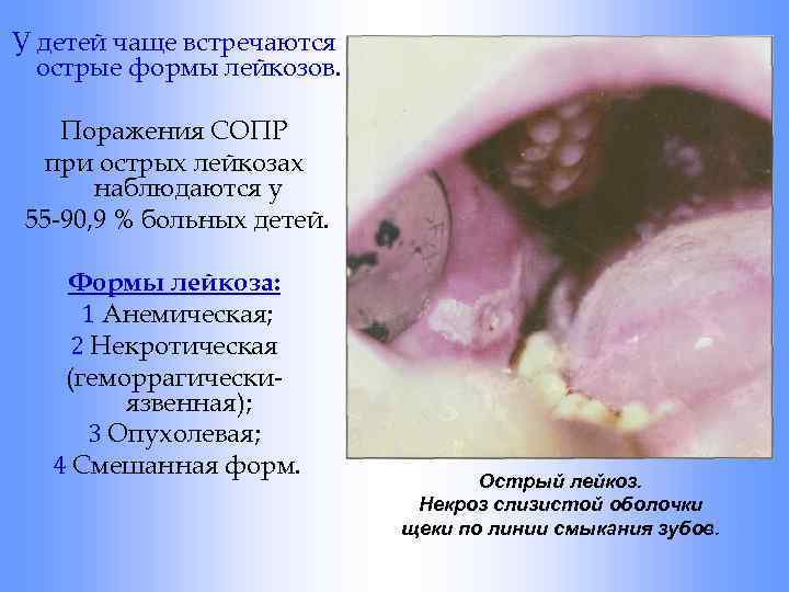 У детей чаще встречаются острые формы лейкозов. Поражения СОПР при острых лейкозах наблюдаются у