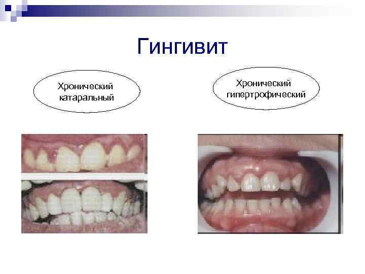 Гингивит Хронический катаральный Хронический гипертрофический 