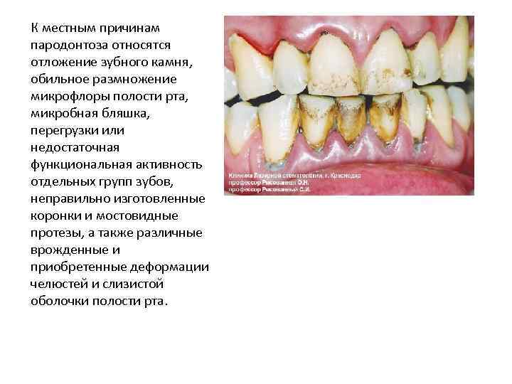 К местным причинам пародонтоза относятся отложение зубного камня, обильное размножение микрофлоры полости рта, микробная
