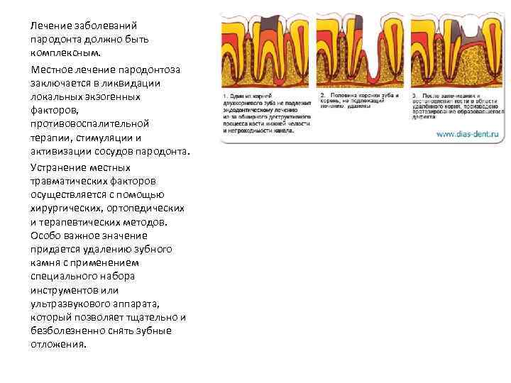 Лечение заболеваний пародонта. Схема лечения пародонтоза. Цель лечения пародонтоза. План лечения при пародонтозе. Пародонтоз план лечения.