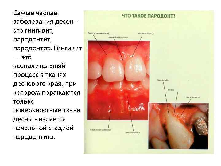 Самые частые заболевания десен это гингивит, пародонтоз. Гингивит — это воспалительный процесс в тканях
