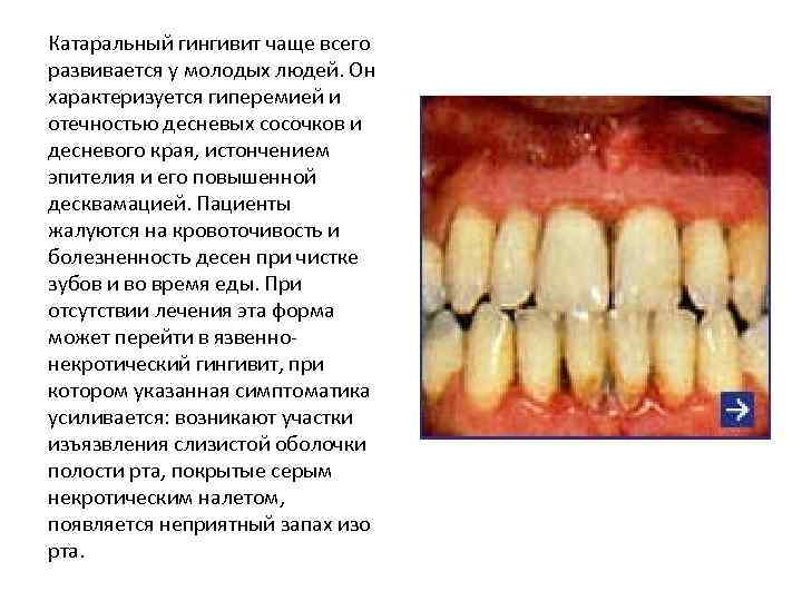 Катаральный гингивит чаще всего развивается у молодых людей. Он характеризуется гиперемией и отечностью десневых