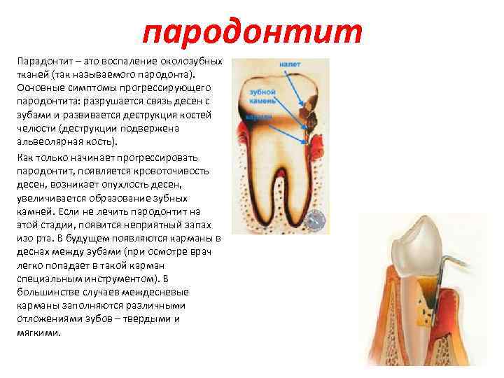 пародонтит Парадонтит – это воспаление околозубных тканей (так называемого пародонта). Основные симптомы прогрессирующего пародонтита: