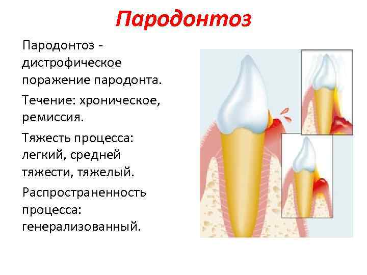 Пародонтоз дистрофическое поражение пародонта. Течение: хроническое, ремиссия. Тяжесть процесса: легкий, средней тяжести, тяжелый. Распространенность