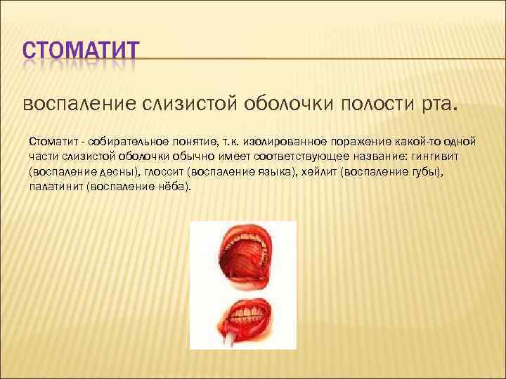 воспаление слизистой оболочки полости рта. Стоматит - собирательное понятие, т. к. изолированное поражение какой-то