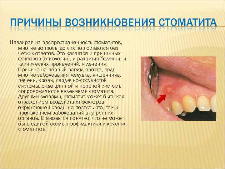 Невзирая на распространенность стоматитов, многие вопросы до сих пор остаются без четких ответов. Это